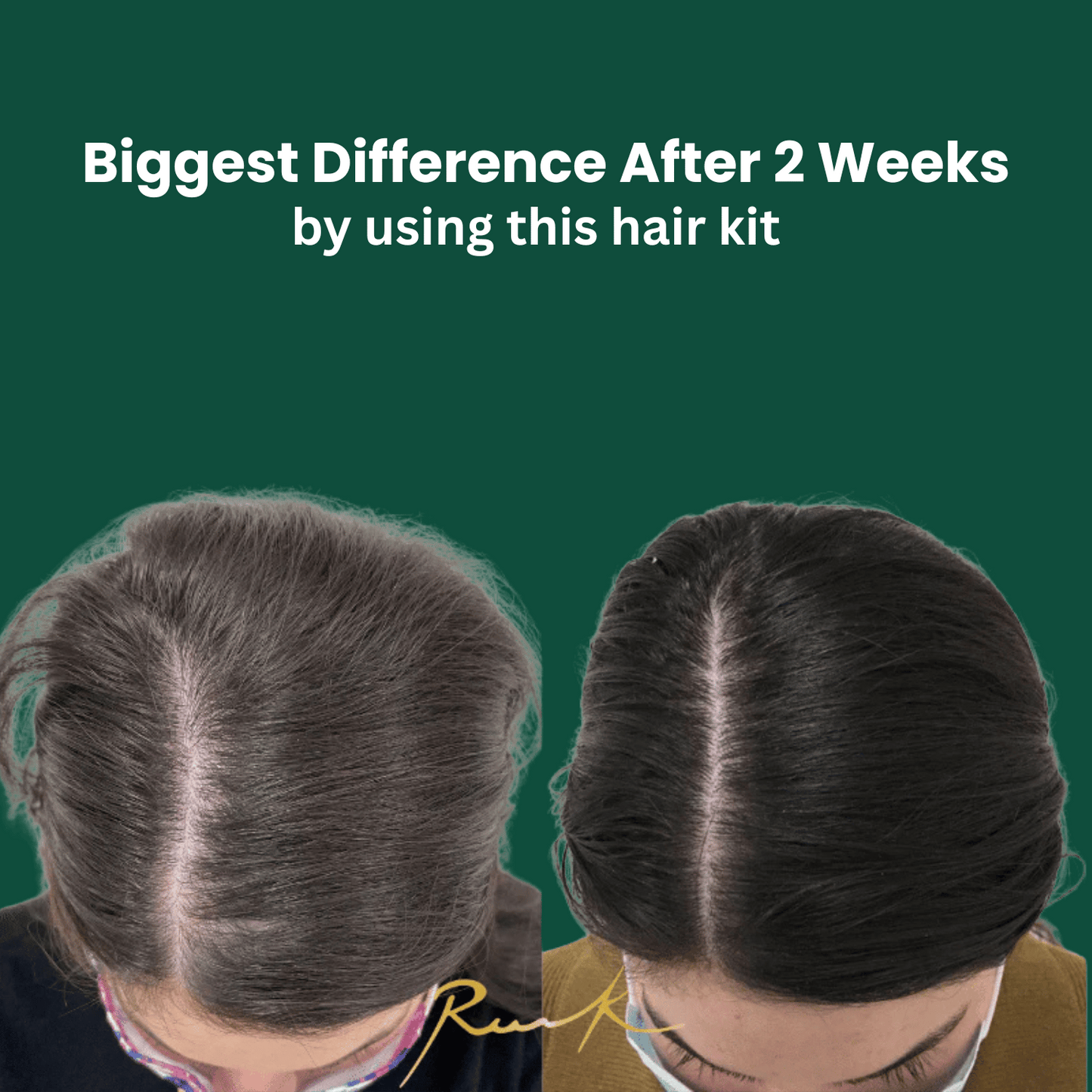 Hair Growth Kit Deal